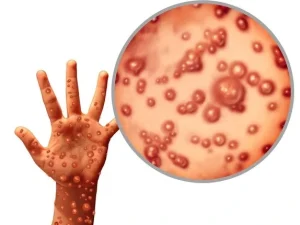 Waspadai Gejala Cacar Monyet, Bila Terindikasi Segera Periksakan