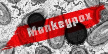 Yuk Kita Kenali Gejala Monkeypox Atau Cacar Monyet