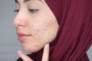Salah Pakai Hijab Bisa Jadi Penyebab Timbulnya Jerawat