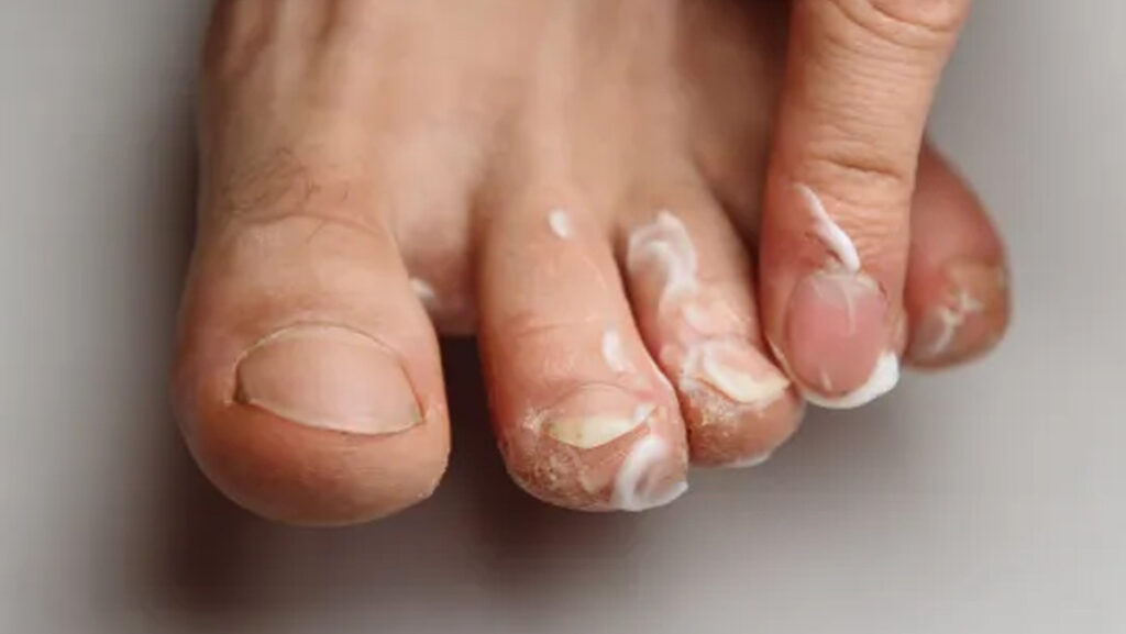 Ternyata Kutu Air Menular dan Bisa Berbahaya Lho