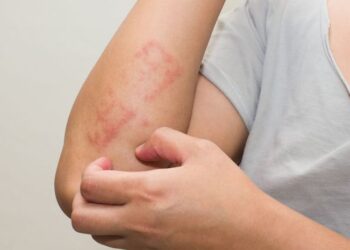 Kenali Ciri Ciri Kulit Ini Bisa Jadi Kamu Kena Diabetes