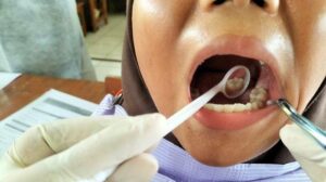 Masalah Kesehatan Gigi Dominasi Keluhan di CKG, Menkes Baru Ngeuh Kalau 50 Persen Puskesmas Tak Ada Dokter Gigi