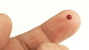 Benarkah Menusukan Jarum ke Jari Bisa Atasi Serangan Stroke? Mitos atau Fakta?