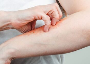 Kenali Ciri Ciri Ginjal Rusak, Kulit jadi Kering, Gatal dan Berubah Warna