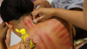 Ternyata Semakin Merah Kerokan Bukan Berarti Masuk Angin, Begini Faktanya