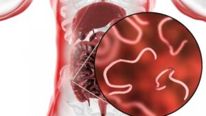 Catat Nih! Daftar Makanan Ini Bisa jadi Penyebab Cacingan